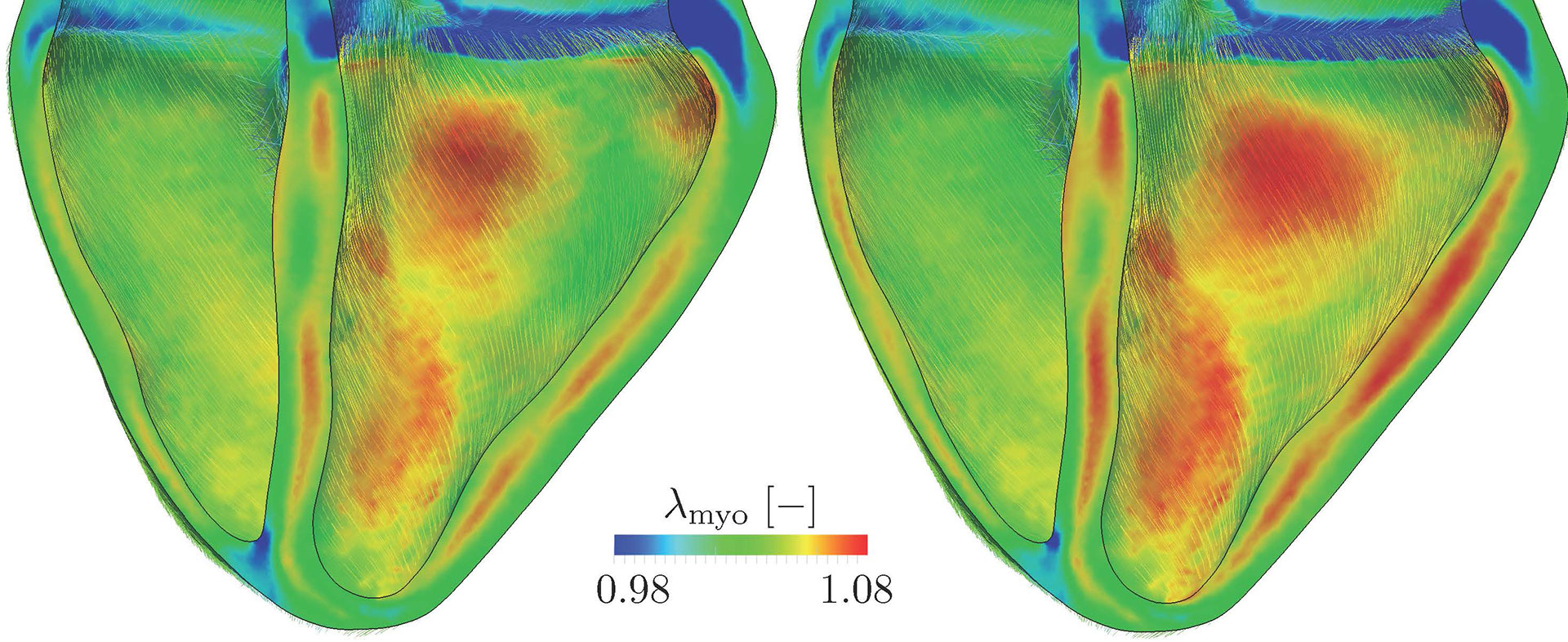 Reverse-Remodeling durch individuelle epikardiale Augmentation