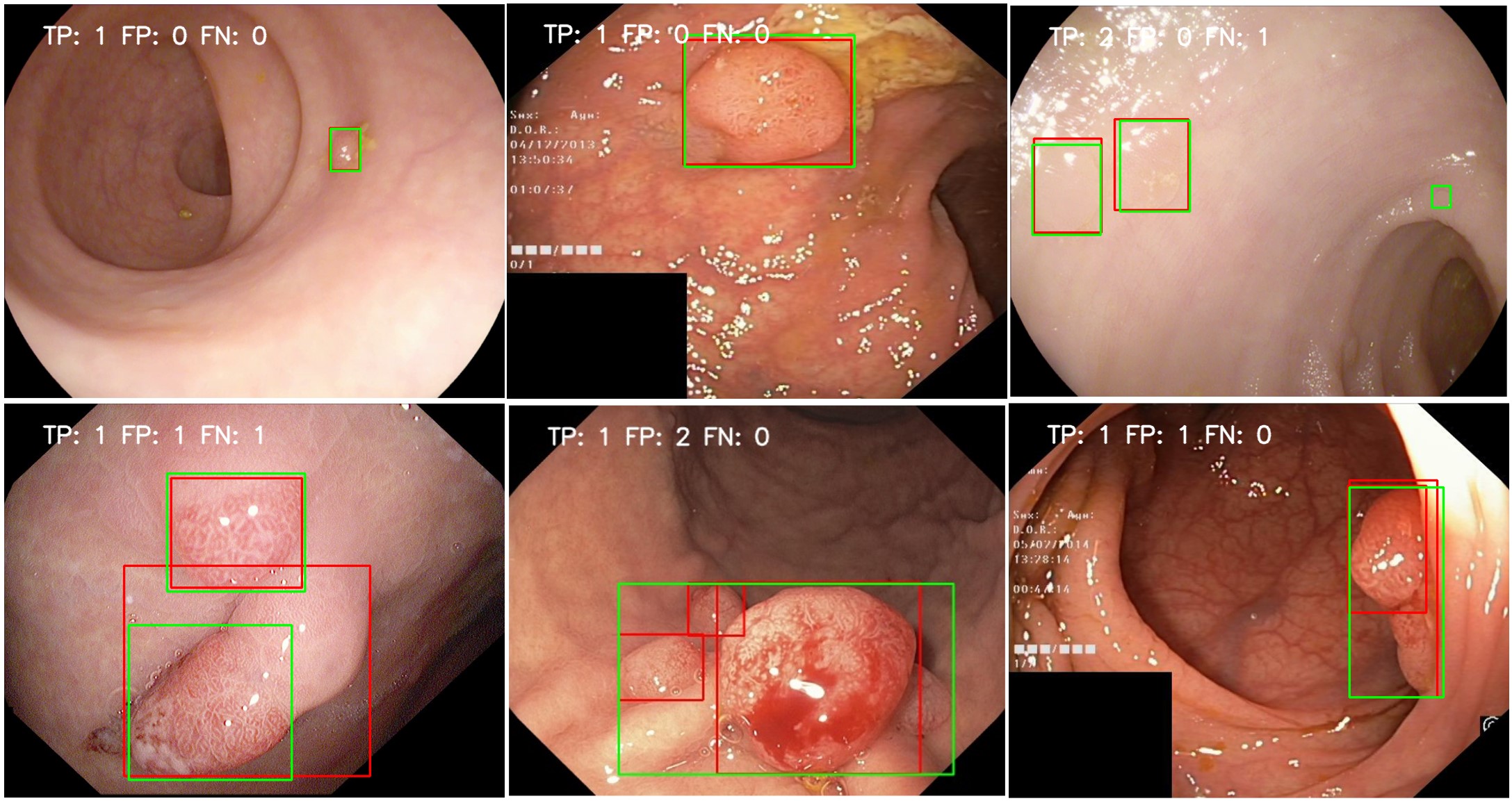 Evaluierungsergebnisse auf Bilddaten öffentlicher koloskopischer Datensammlungen (Kvasir, ETIS Larib, CVC ClinicDB). Grünes Rechteck: bekannte Grundwahrheit, rotes Rechteck: Vorhersage durch KI. (Quelle: Fraunhofer-Institut für Integrierte Schaltungen IIS, Malteser Waldkrankenhaus St. Marien)