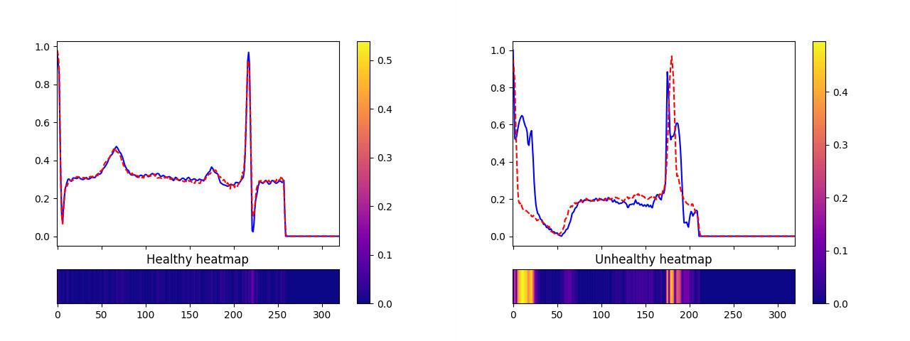 Vergleich eines realen Herzschlags (blau) mit der Rekonstruktion (rot). Die Farbintensität der Heatmap stellt den Abstand zwischen dem realen und synthetischen Herzschlag dar. Der normale (healthy) Herzschlag kann detailliert rekonstruiert werden, der anormale Herzschlag ist wie zu erwarten nicht durch das Model rekonstruierbar, da das Netzwerk nur auf Daten der normalen Klasse trainiert wird. (Quelle: eMundo GmbH)