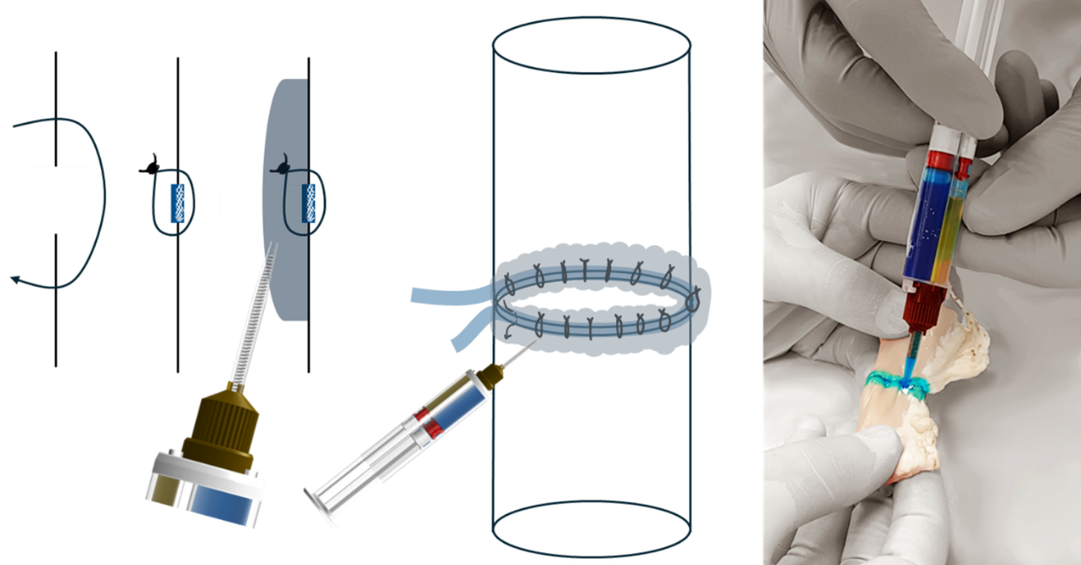 Schematische Darstellung des Applikationsprinzips zur zirkulären Aufbringung des kollagenbasierten Klebers auf die intestinale Anastomose sowie exemplarische Anwendung am Ex-vivo-Präparat (Quelle: Technische Universität München, Klinik und Poliklinik für Chirurgie TUM Klinikum, Rechts der Isar, PD Dr. Philipp-Alexander Neumann und Dr. med. Kamacay Cira)