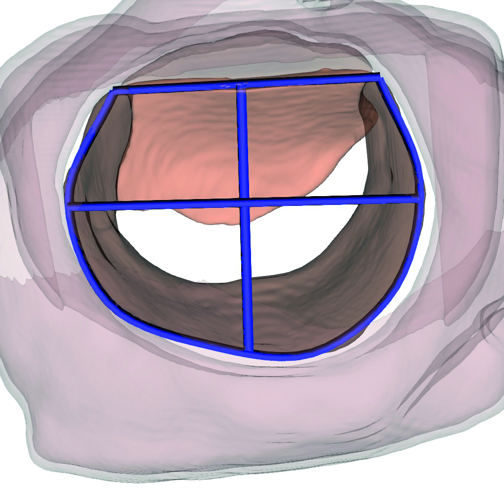 Automatisierte Segmentierung eines transösophagealen Bildes der Mitralklappe mittels künstlicher Intelligenz (Quelle: LMU Klinikum der Universität München, Medizinische Klinik und Poliklinik, Department of Cardiology)
