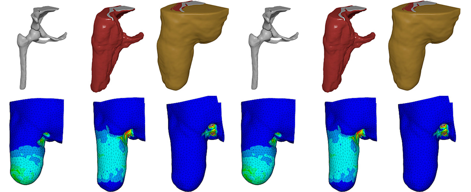 Segmentierungen der internen Anatomie des Oberschenkelstumpfes eines Beinamputierten, Beckenknochen und residualer Knochen, Muskulatur und das darüber liegende Weichgewebe (Quelle: TUM, Klinikum rechts der Isar, Klinik und Poliklinik für Plastische Chirurgie und Handchirurgie)