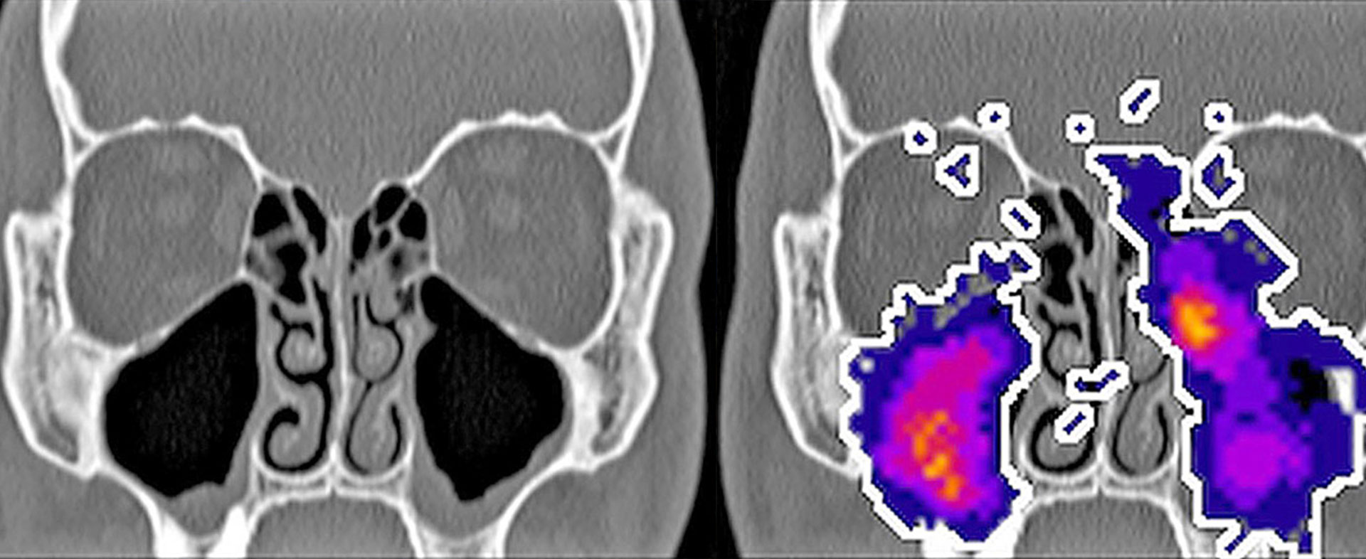 Aerosoltherapie der oberen Atemwege und Nasennebenhöhlen