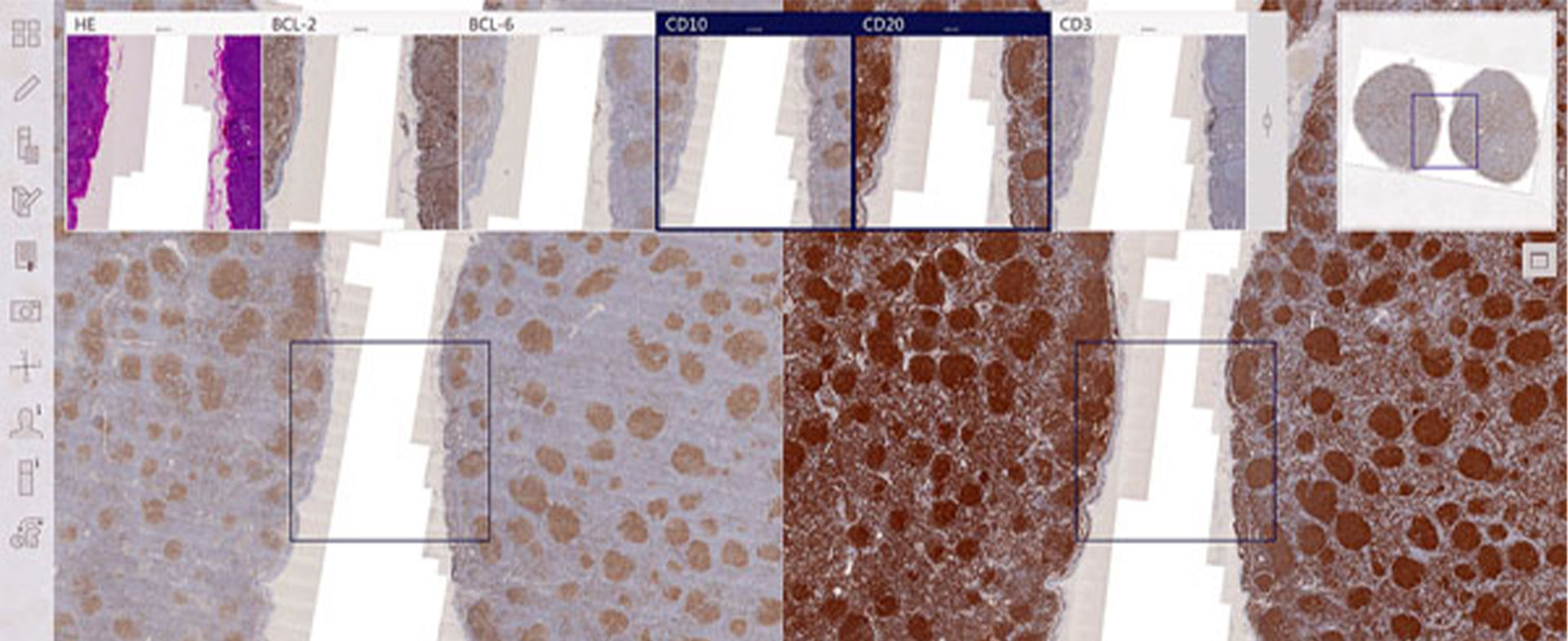 Computerassistierte histologische Befundung am Beispiel von Knochenmark- und Lymphknotenuntersuchungen – PathoMaps