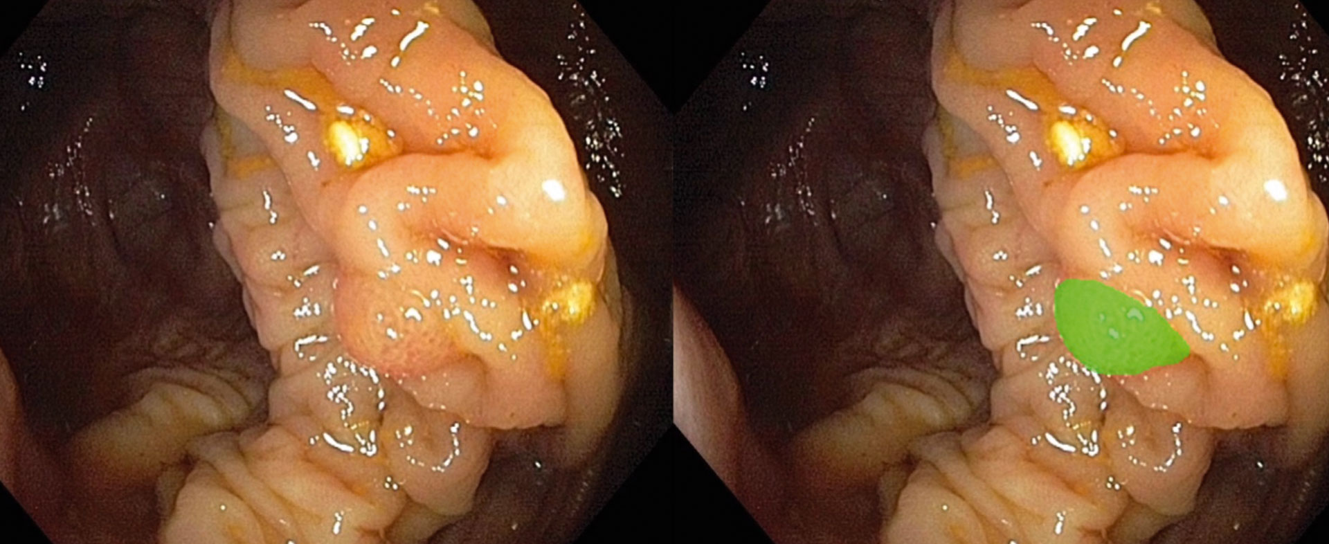 Deep Colonoscopy: Bildbasierte Detektion von Läsionen in Echtzeit während der Koloskopie
